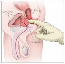 Prostatectomia