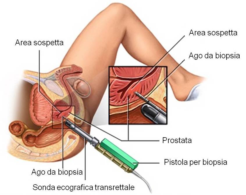 visita prostata)