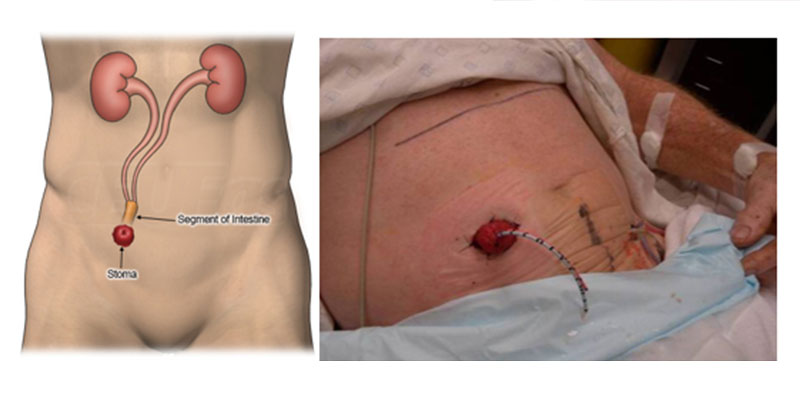 papilloma vescicale intervento chirurgico