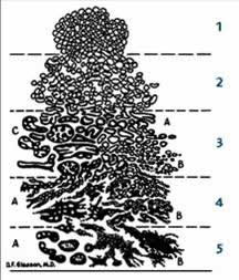 cancroprost3