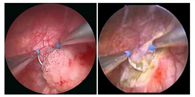 papilloma alla vescica negli uomini