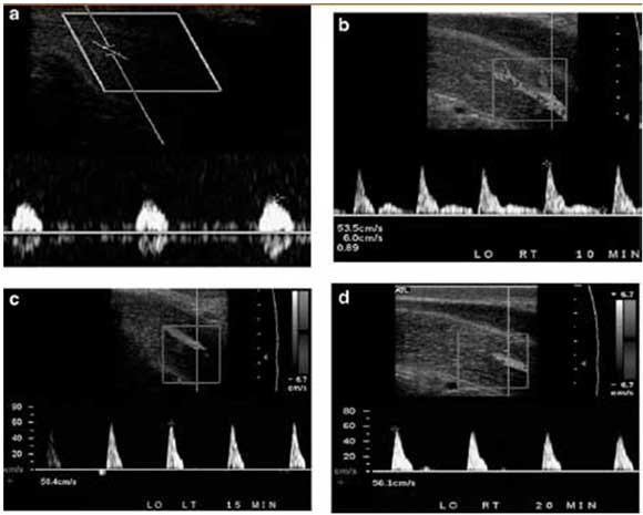 Disfunzione Erettile ecodoppler penieno