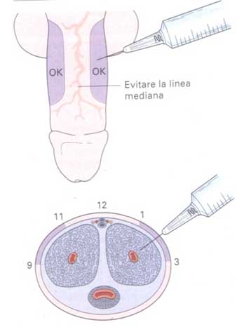 Disfunzione Erettile - Farmacoterapia intracavernosa