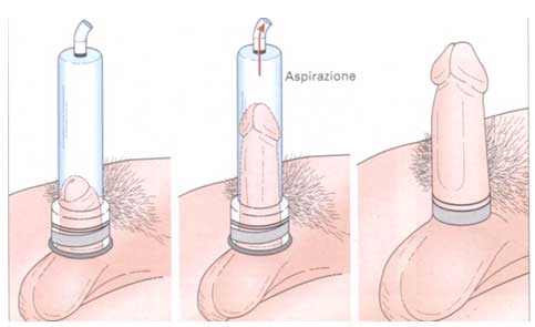 Disfunzione Erettile Vacuum Device