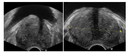 Volume prostata