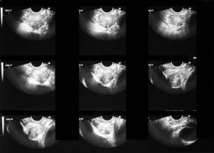 Operazione ipertrofia prostatica