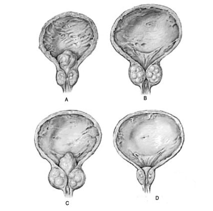 prostata adenomatosa bilobata