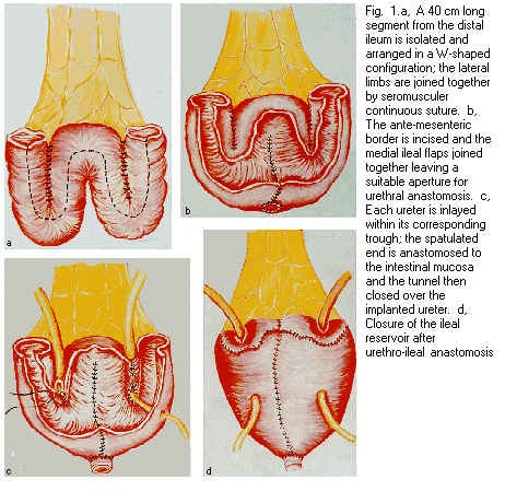 papilloma vescicale t1