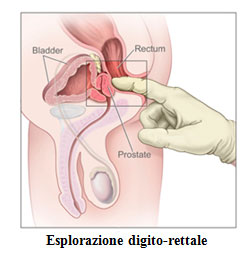zona periferica prostata dishomogenea