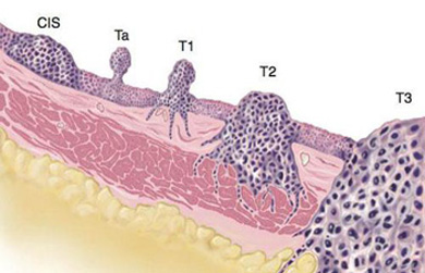 Resezione papilloma vescicale - Tratamentul viermilor în complexul copiilor