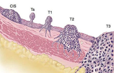 Prostata terapia