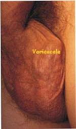 Varicocele