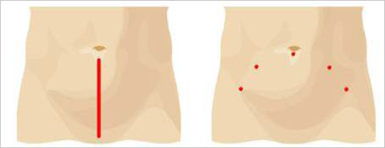 prostatectomia radicale laparoscopica)