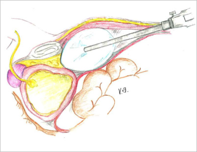 prostatectomia radicale laparoscopica