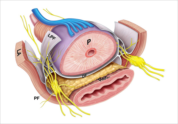 prostatectomia radicale laparoscopica transperitoneale