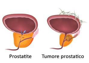 prostata sintomi della malattia