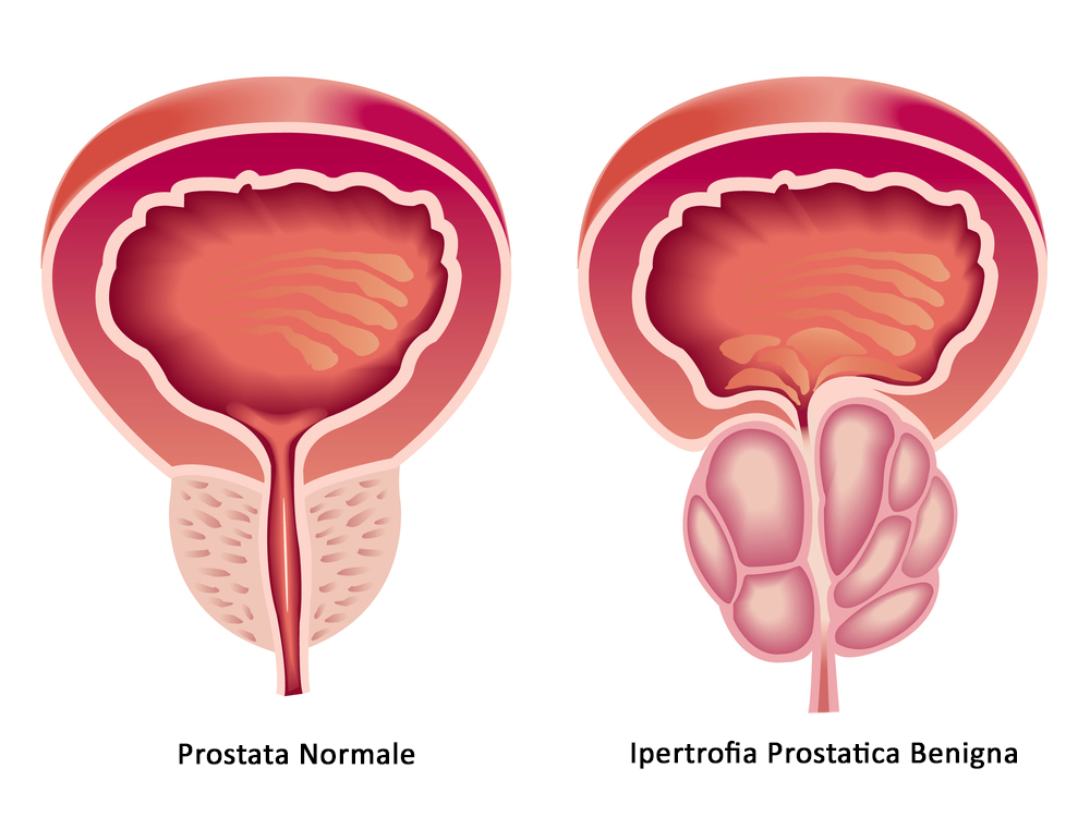 Problemi alla prostata