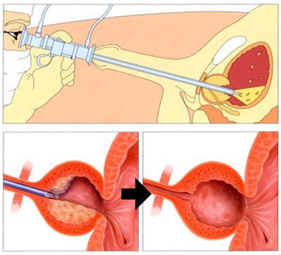 prostata ingrossata intervento endoscopico)
