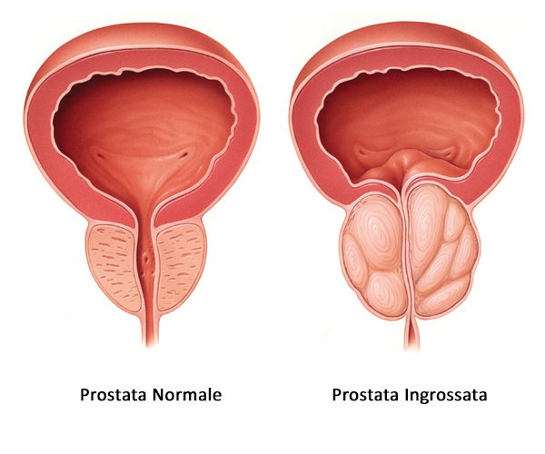 Prostata ingrossata sintomi